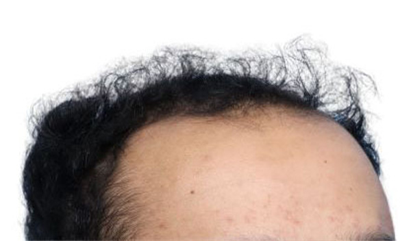 Fue Before and After | Dr. Jeffrey Wise