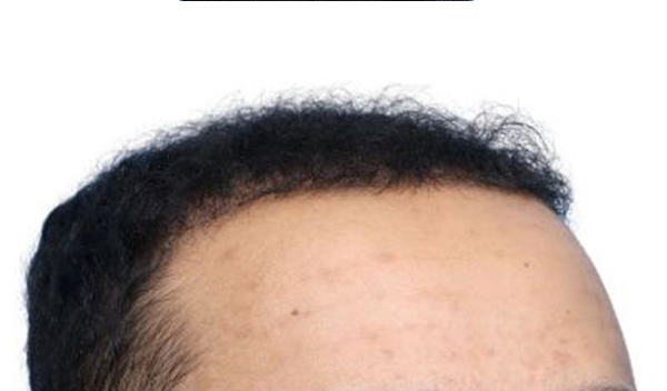 Fue Before and After | Dr. Jeffrey Wise