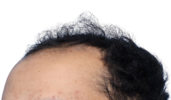 Fue Before and After | Dr. Jeffrey Wise