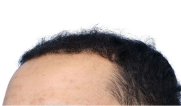 Fue Before and After | Dr. Jeffrey Wise