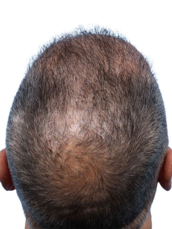 Fue Before and After | Dr. Jeffrey Wise