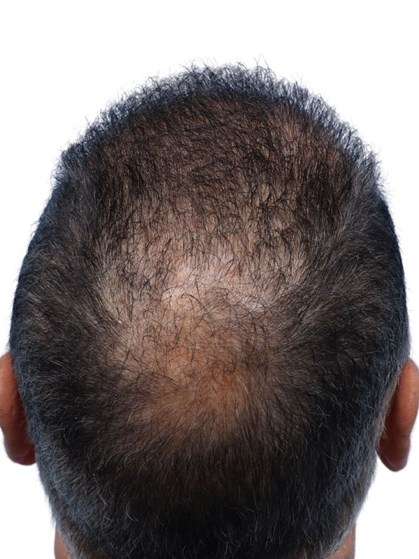 Fue Before and After | Dr. Jeffrey Wise