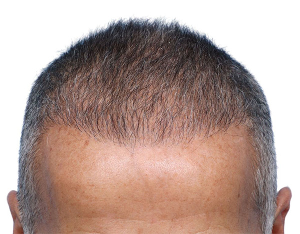 Fue Before and After | Dr. Jeffrey Wise