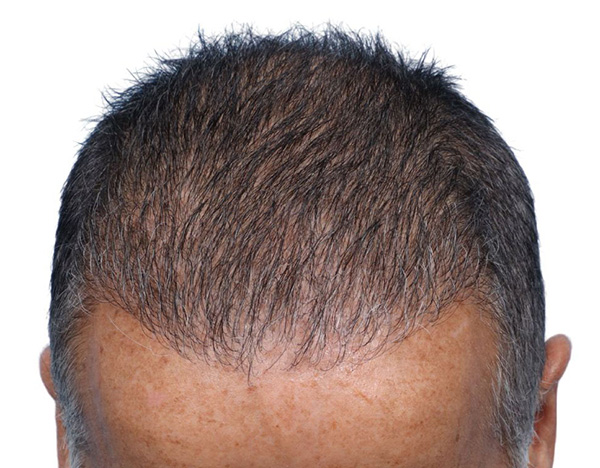 Fue Before and After | Dr. Jeffrey Wise