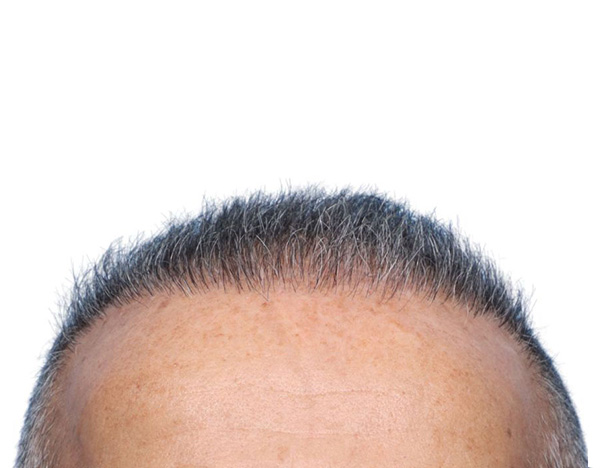 Fue Before and After | Dr. Jeffrey Wise