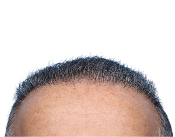 Fue Before and After | Dr. Jeffrey Wise
