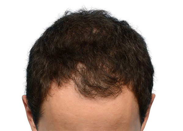 Fue Before and After | Dr. Jeffrey Wise