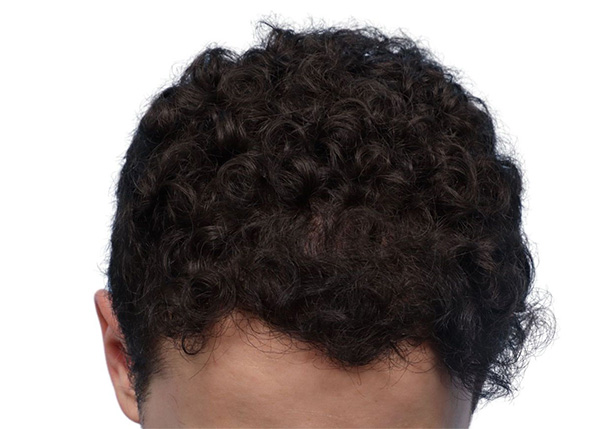 Fue Before and After | Dr. Jeffrey Wise