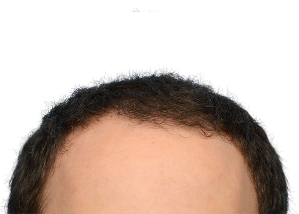 Fue Before and After | Dr. Jeffrey Wise
