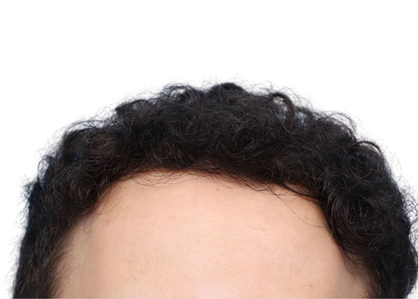 Fue Before and After | Dr. Jeffrey Wise
