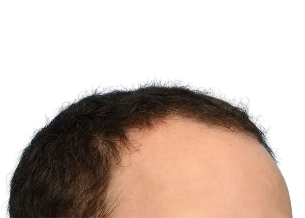 Fue Before and After | Dr. Jeffrey Wise