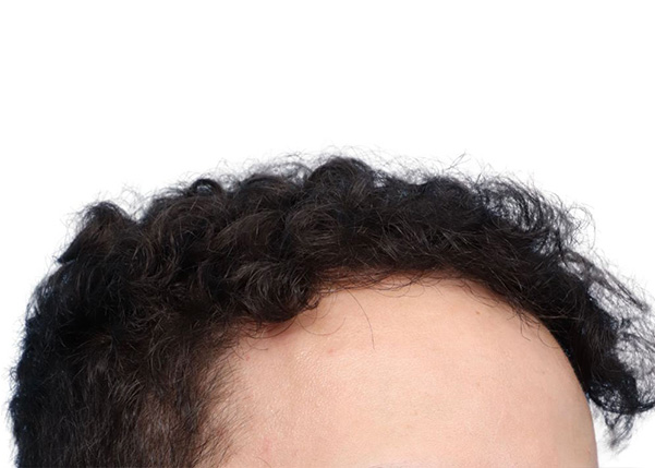Fue Before and After | Dr. Jeffrey Wise