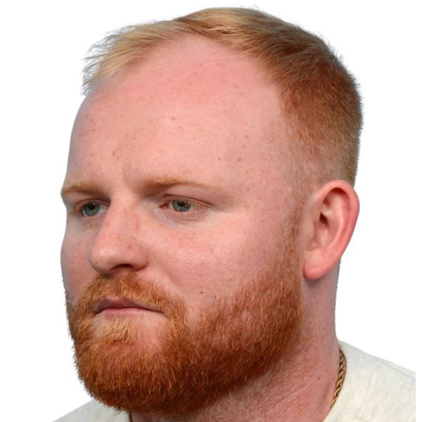 Fue Before and After | Dr. Jeffrey Wise