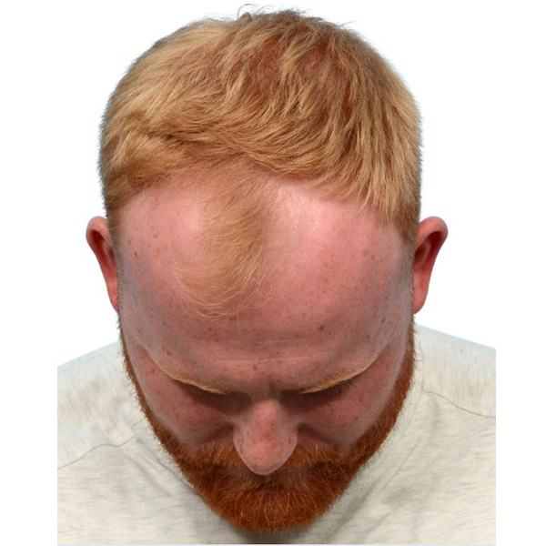 Fue Before and After | Dr. Jeffrey Wise