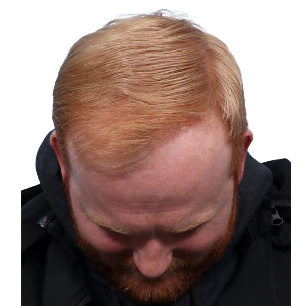 Fue Before and After | Dr. Jeffrey Wise
