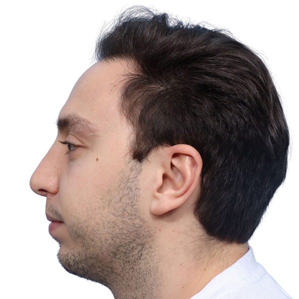 Fue Before and After | Dr. Jeffrey Wise