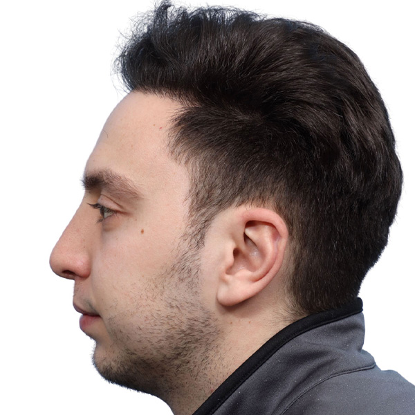 Fue Before and After | Dr. Jeffrey Wise