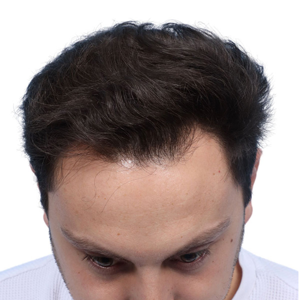 Fue Before and After | Dr. Jeffrey Wise