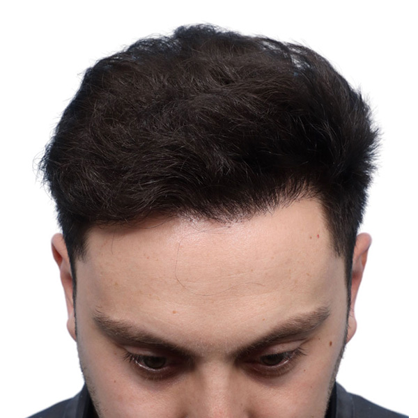 Fue Before and After | Dr. Jeffrey Wise