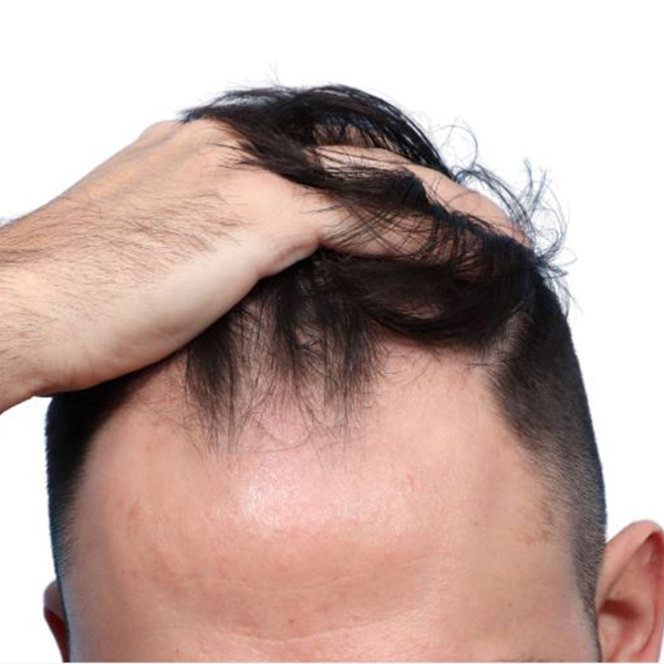 Fue Before and After | Dr. Jeffrey Wise