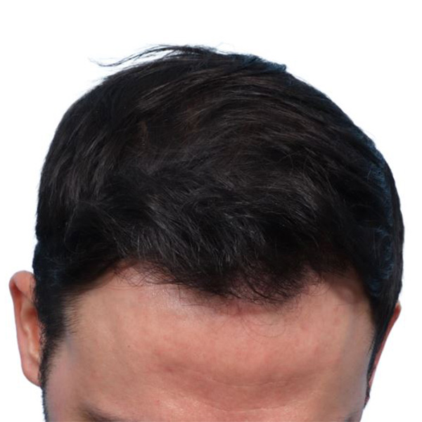 Fue Before and After | Dr. Jeffrey Wise