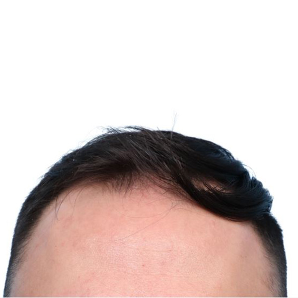 Fue Before and After | Dr. Jeffrey Wise