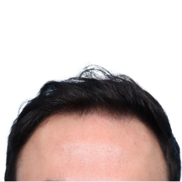 Fue Before and After | Dr. Jeffrey Wise