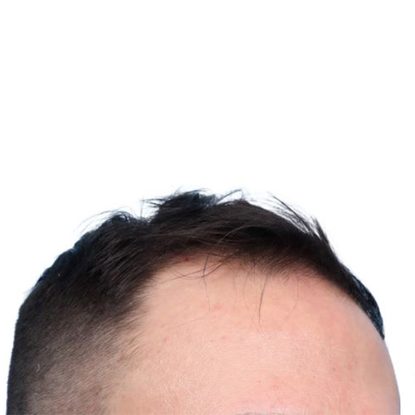 Fue Before and After | Dr. Jeffrey Wise