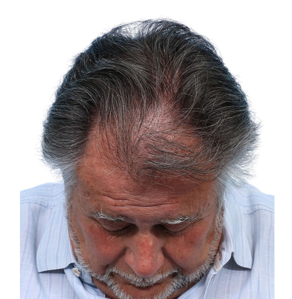 Fue Before and After | Dr. Jeffrey Wise