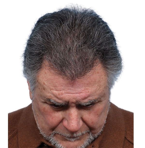 Fue Before and After | Dr. Jeffrey Wise