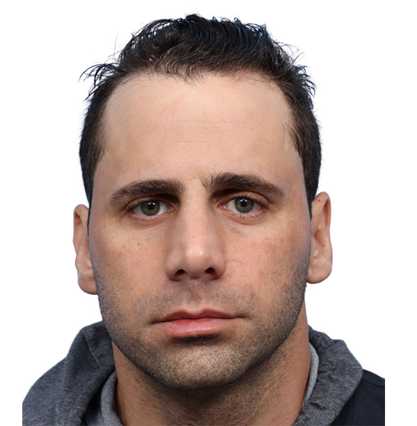 Fue Before and After | Dr. Jeffrey Wise