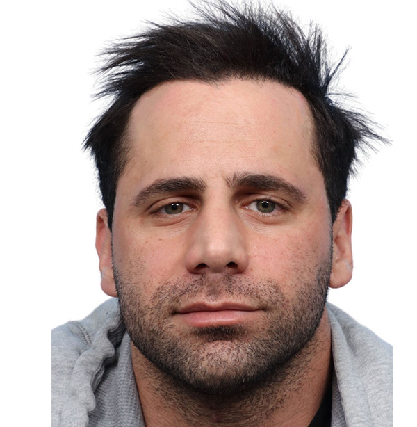 Fue Before and After | Dr. Jeffrey Wise