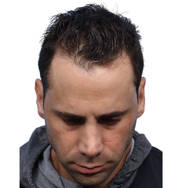 Fue Before and After | Dr. Jeffrey Wise
