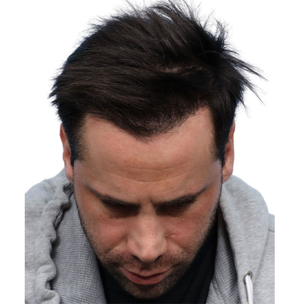 Fue Before and After | Dr. Jeffrey Wise