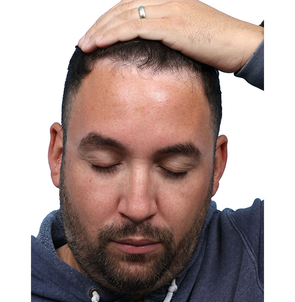 Fue Before and After | Dr. Jeffrey Wise