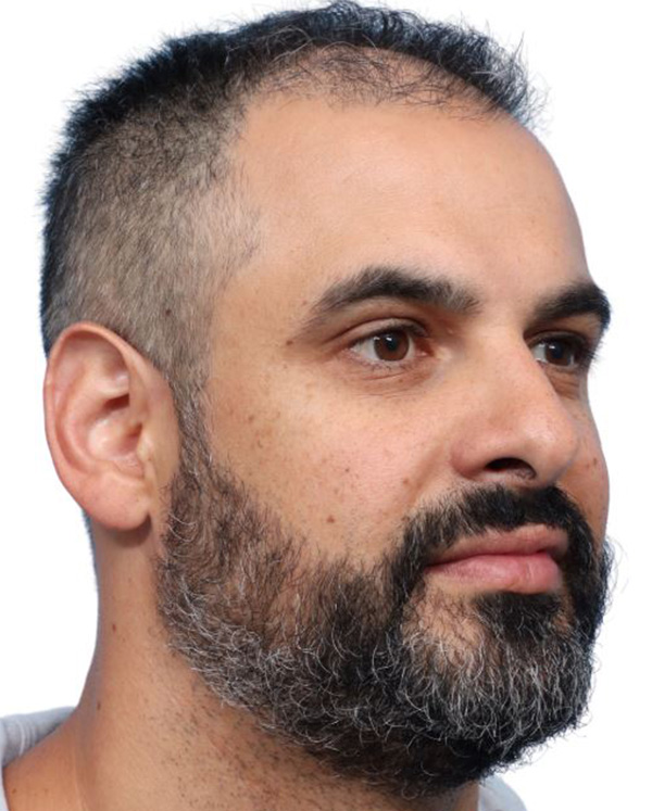 Fue Before and After | Dr. Jeffrey Wise