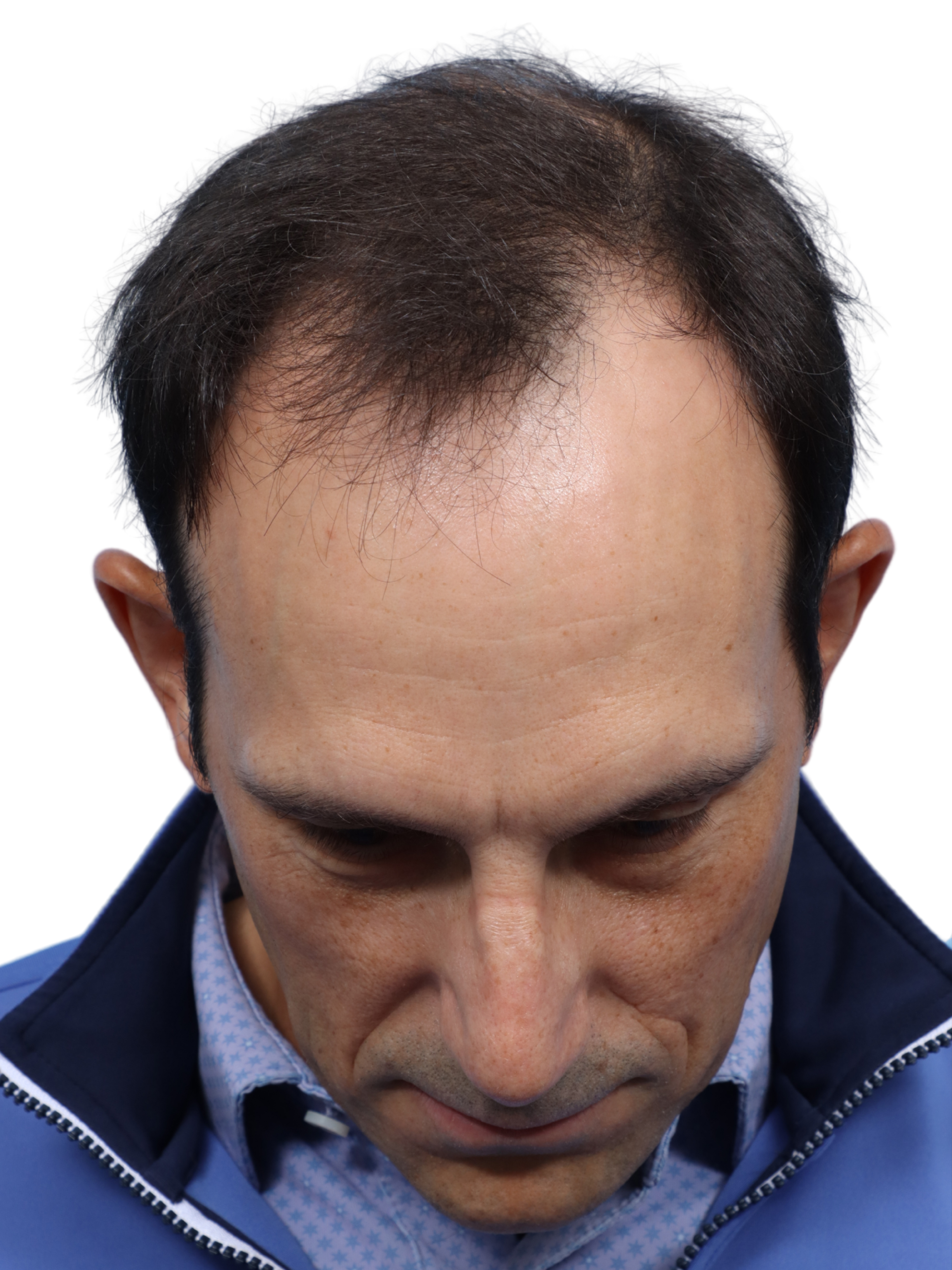 Fue Before and After | Dr. Jeffrey Wise