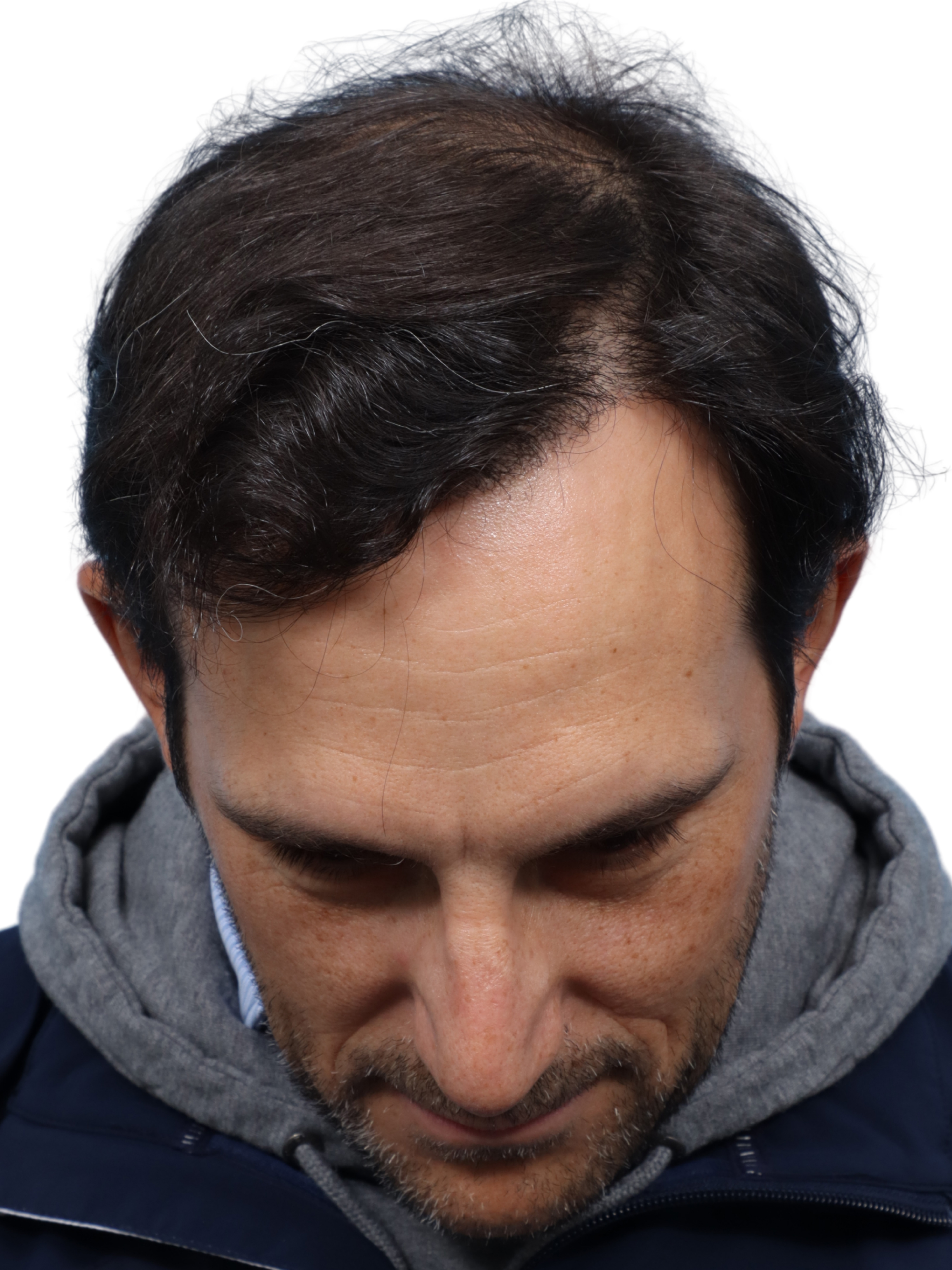 Fue Before and After | Dr. Jeffrey Wise
