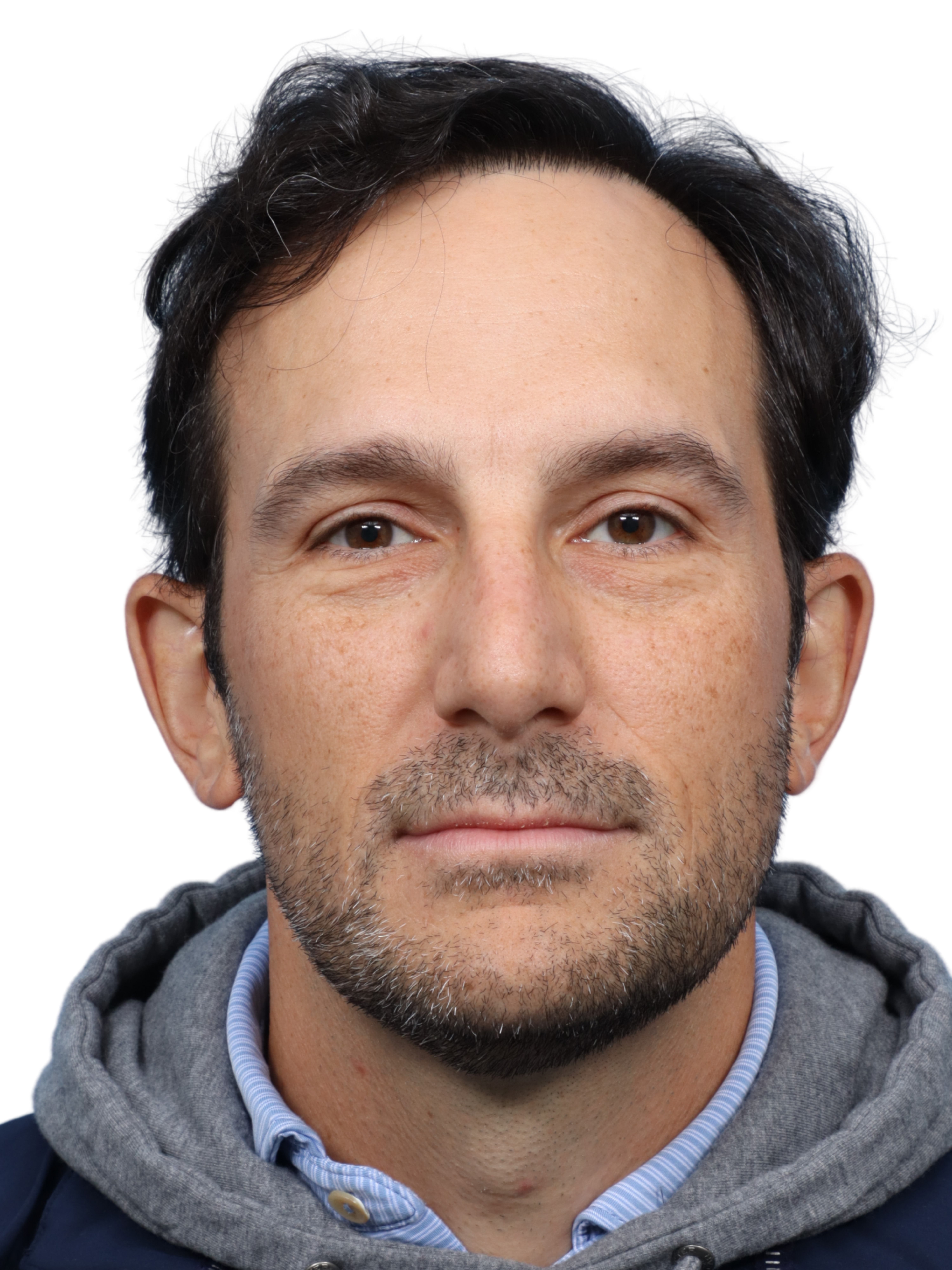 Fue Before and After | Dr. Jeffrey Wise