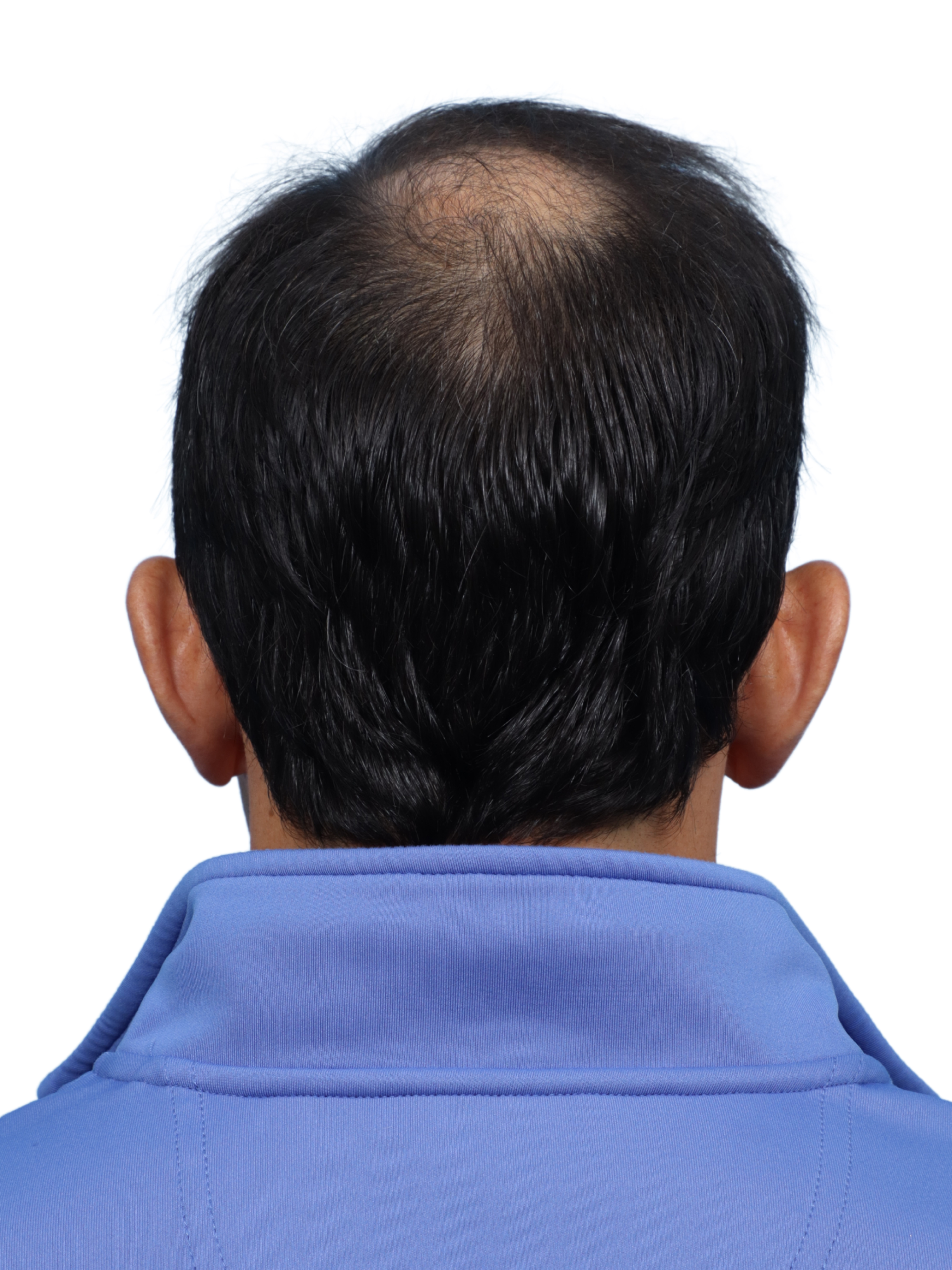 Fue Before and After | Dr. Jeffrey Wise