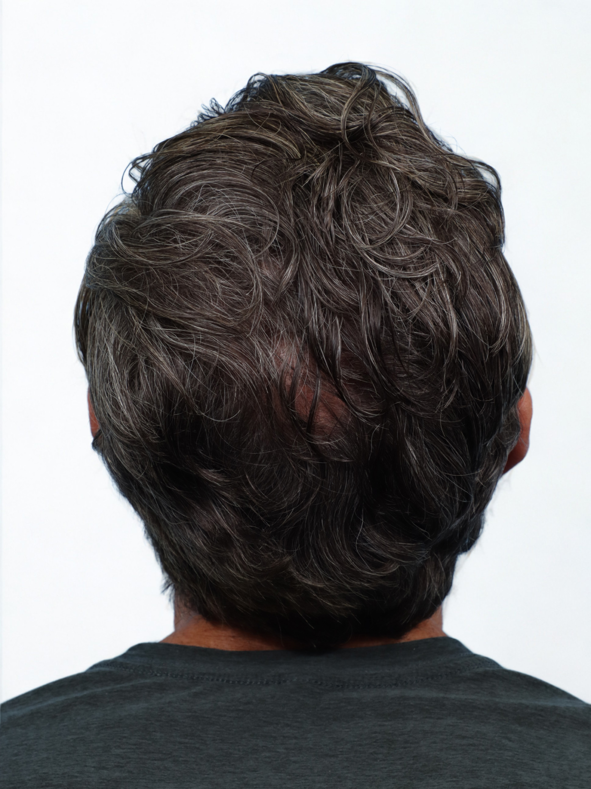 Fue Before and After | Dr. Jeffrey Wise