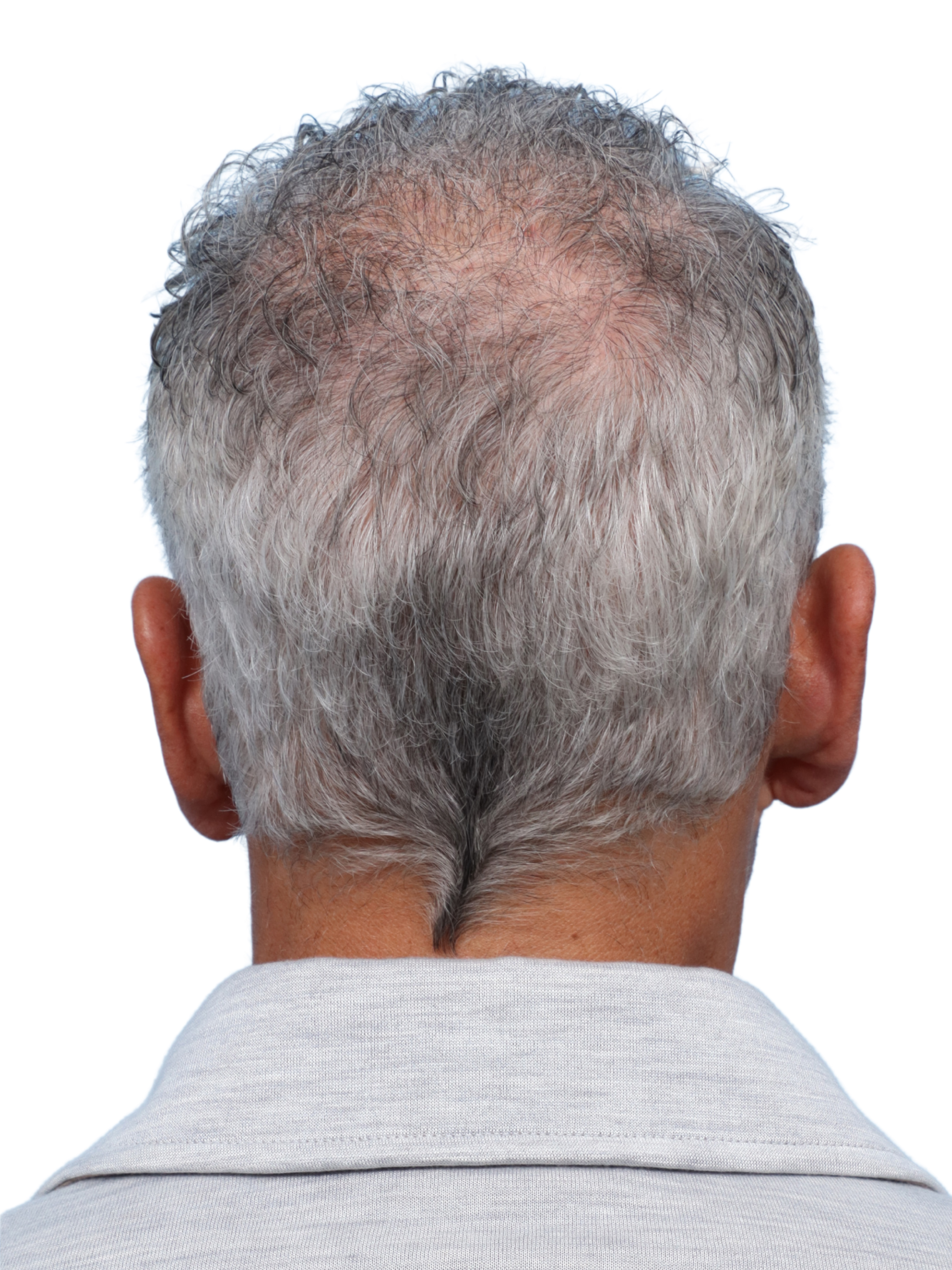 Fue Before and After | Dr. Jeffrey Wise