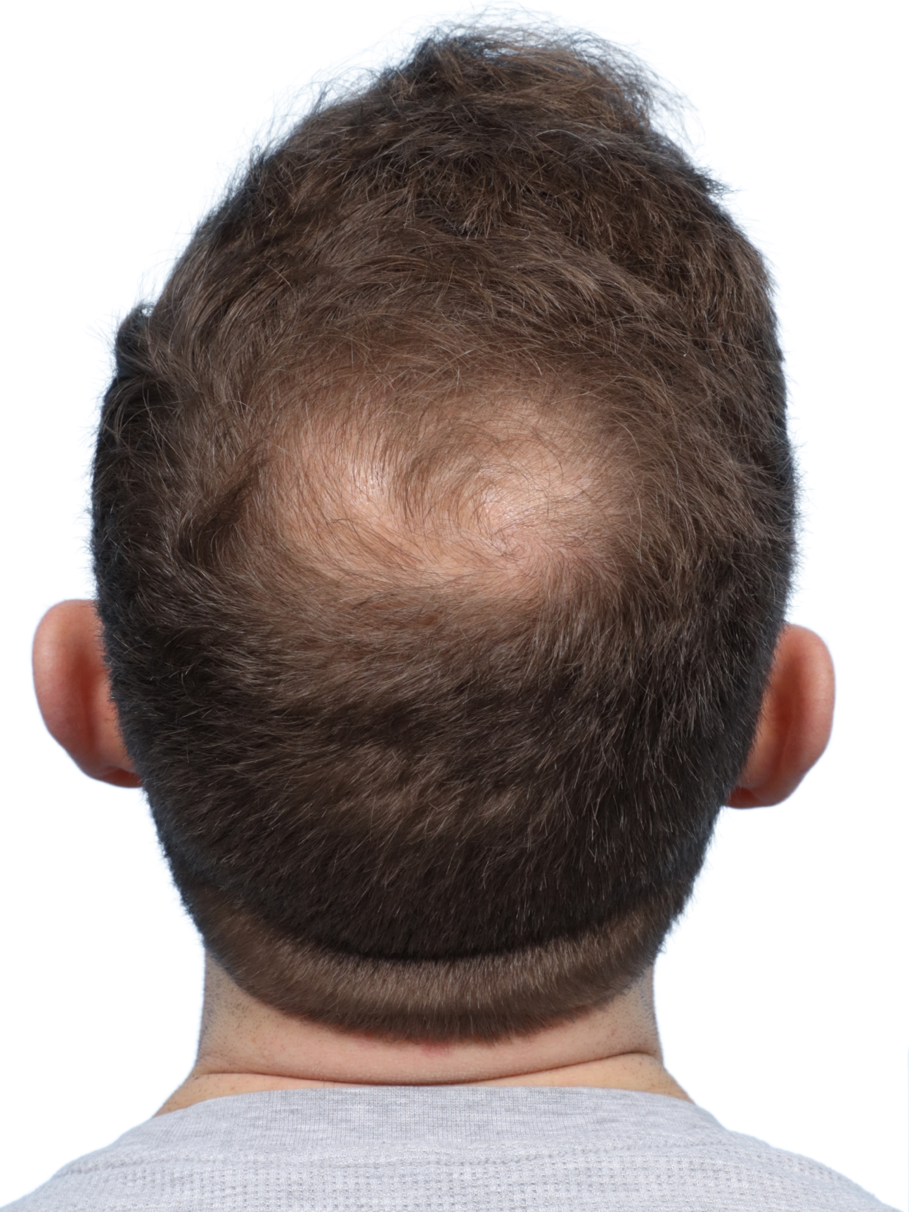 Fue Before and After | Dr. Jeffrey Wise