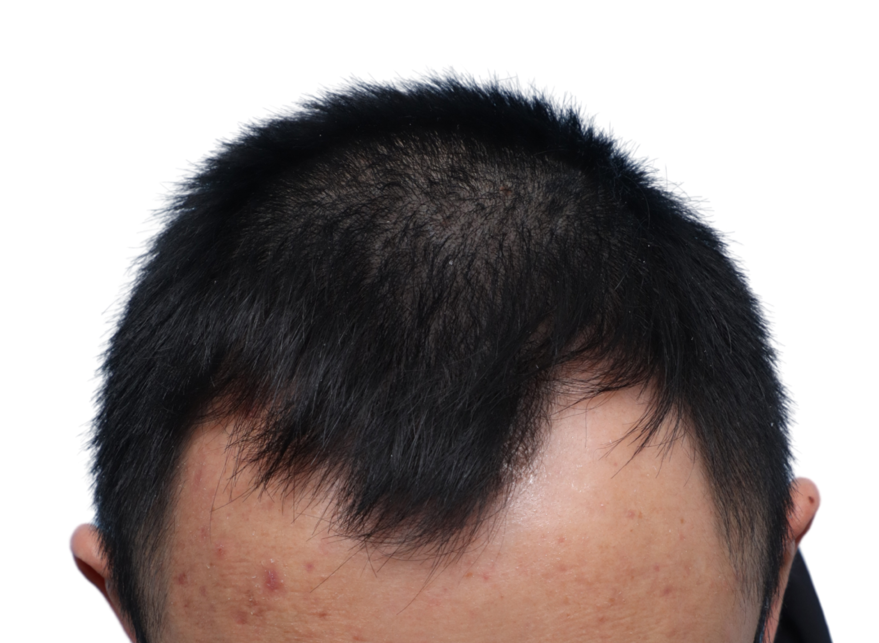 Fue Before and After | Dr. Jeffrey Wise