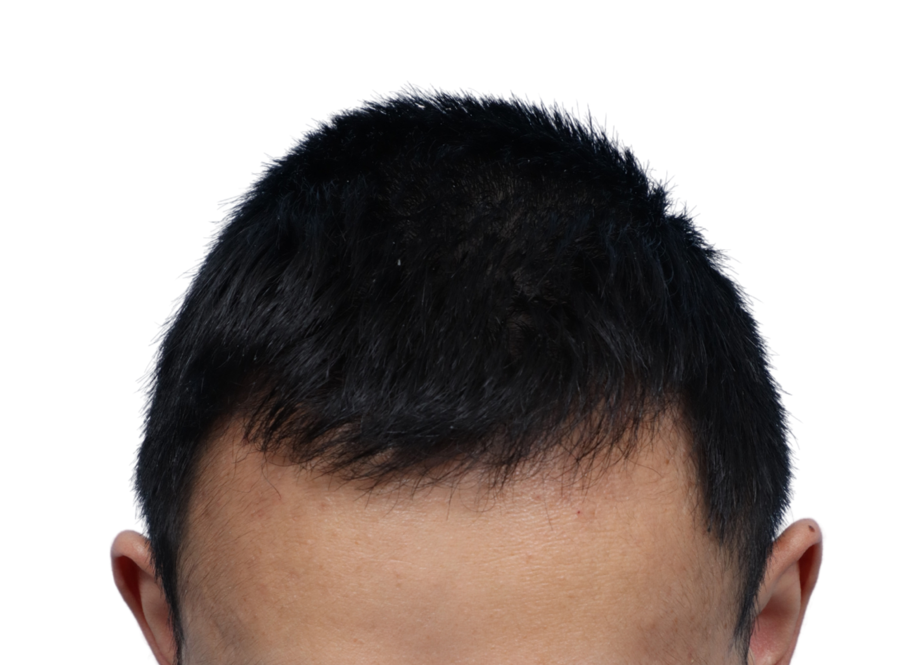 Fue Before and After | Dr. Jeffrey Wise