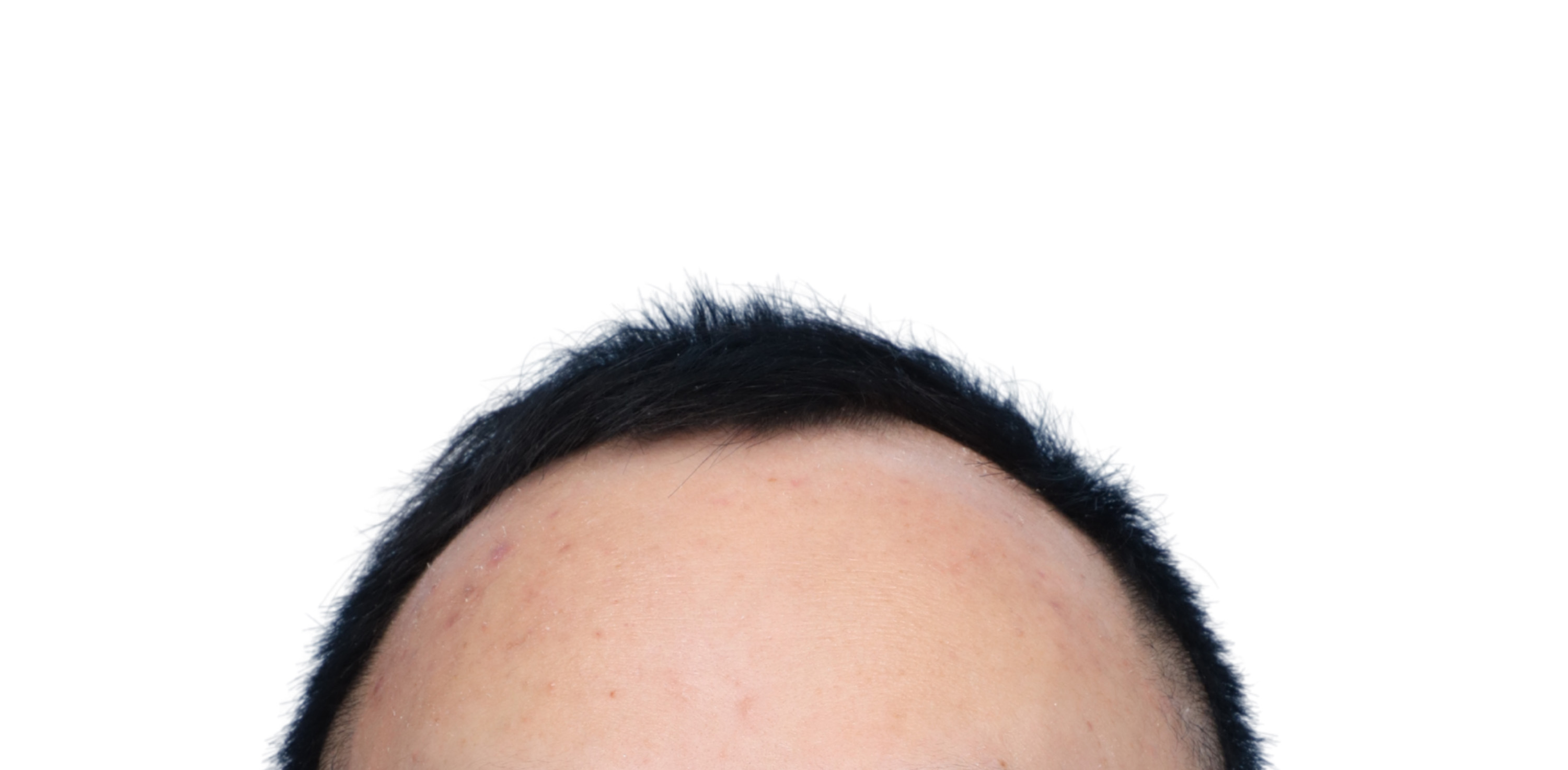 Fue Before and After | Dr. Jeffrey Wise