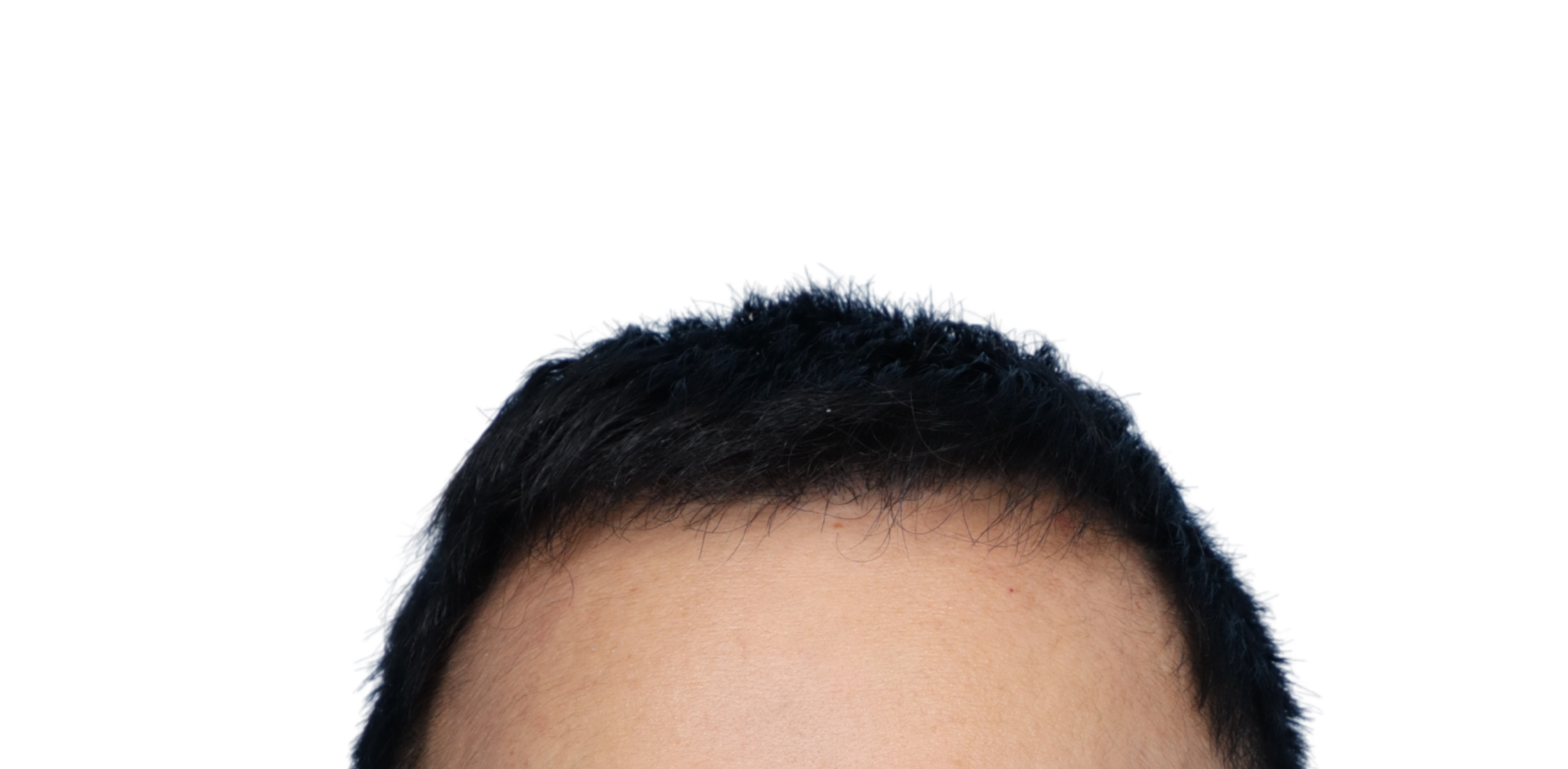 Fue Before and After | Dr. Jeffrey Wise