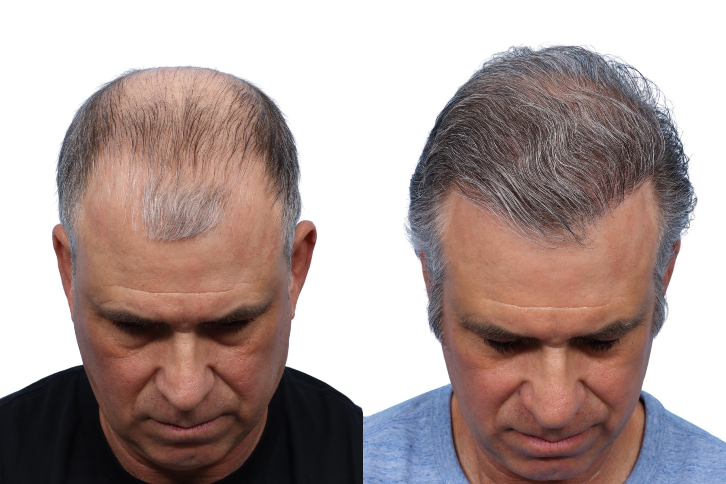 FUE hair transplant 6 months post op — 53-year-old patient, 4,050 grafts | Dr. Jeffrey Wise, NJ