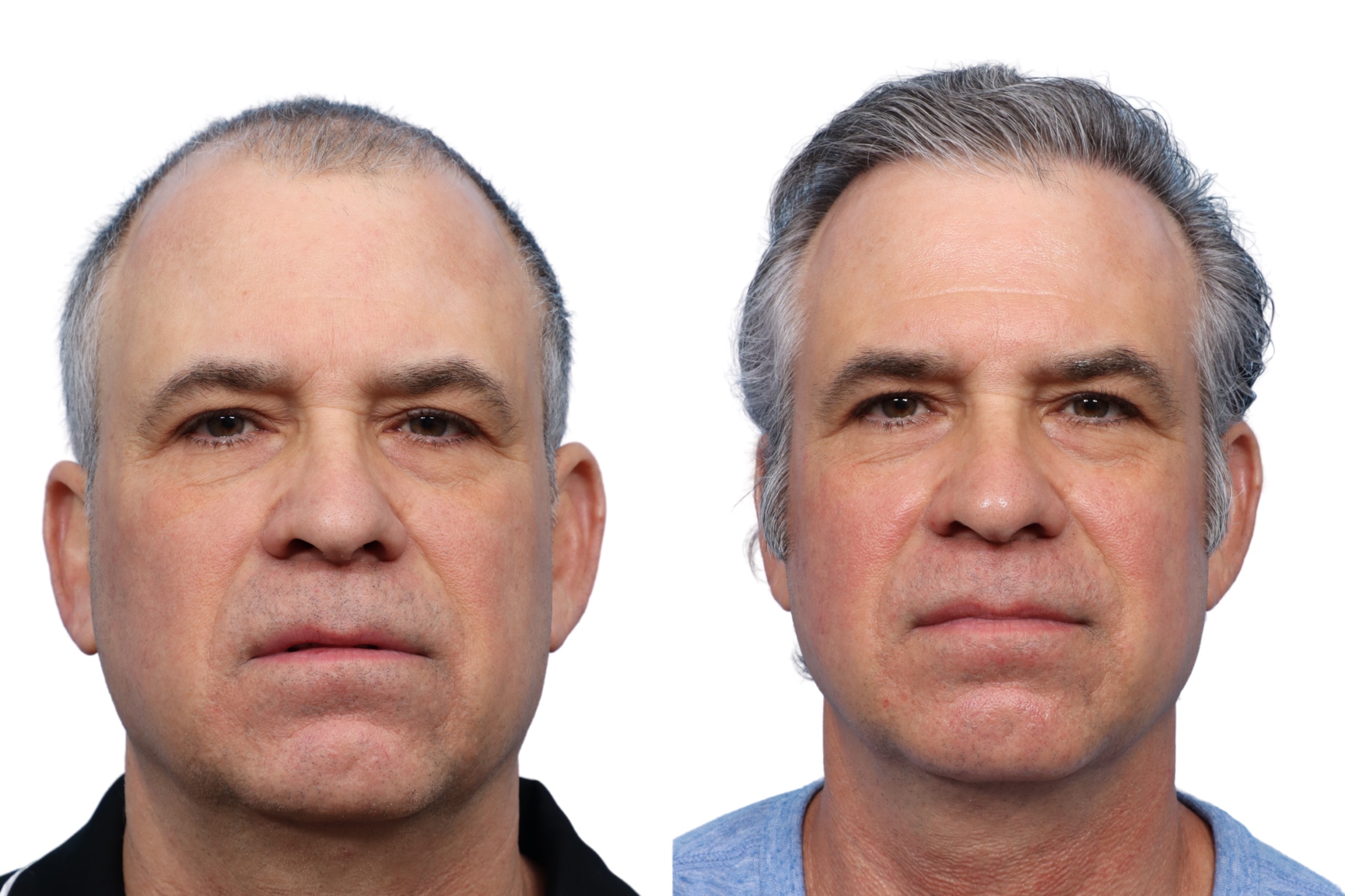 FUE hair transplant 6 months post op — 53-year-old patient, 4,050 grafts | Dr. Jeffrey Wise, NJ