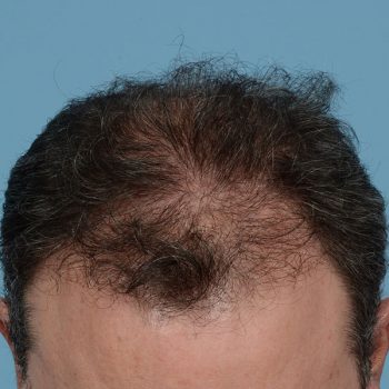 Fue Before and After | Dr. Jeffrey Wise